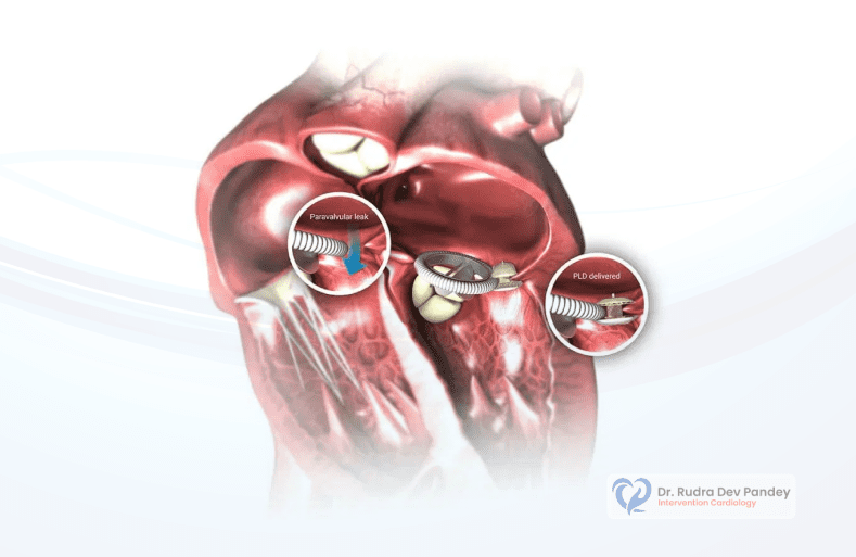 Candidate for Paravalvular Leak Closure_