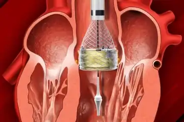 TAVR/TAVI