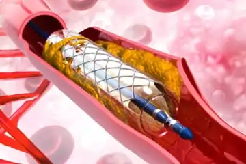 Complex Coronary Angioplasty