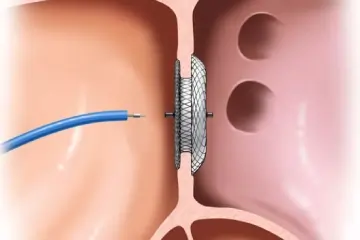 Device Closure ASD/VSD/PDA