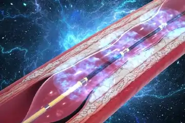 Intravascular Lithotripsy (IVL)