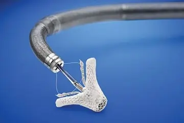 Mitraclip