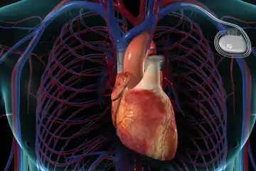 Pacemaker Implantation