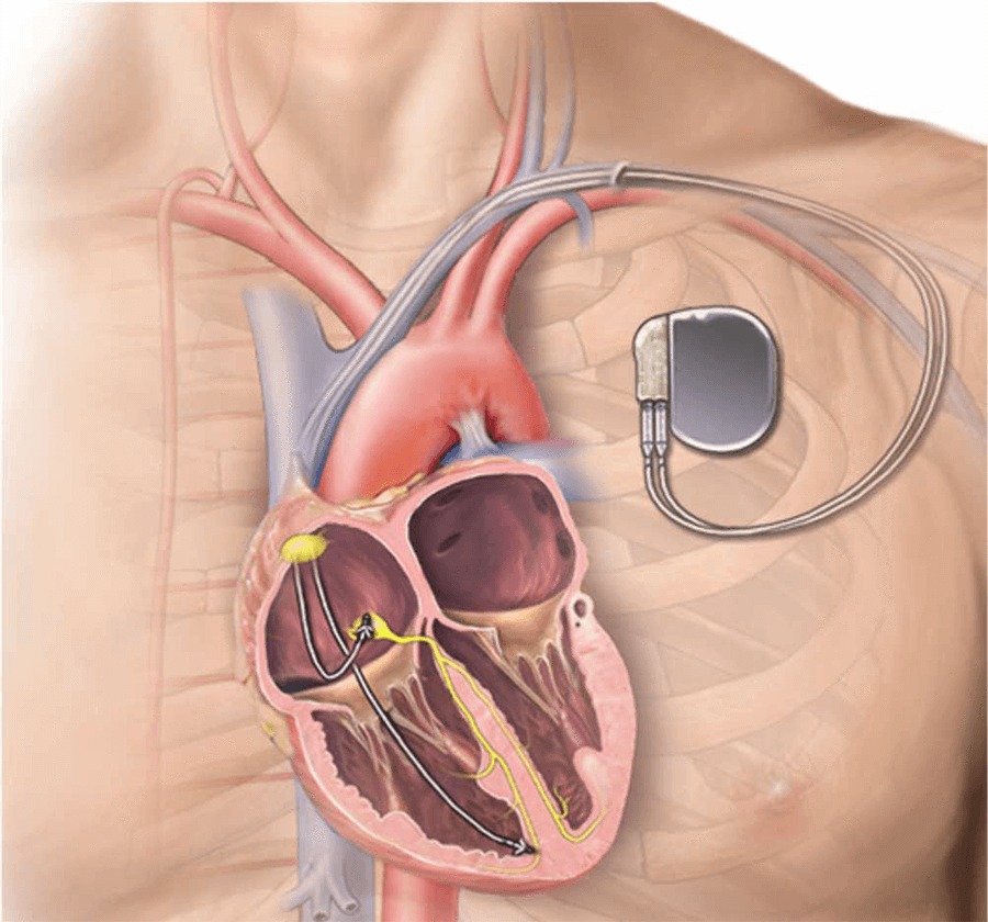 Leadless Pacemaker