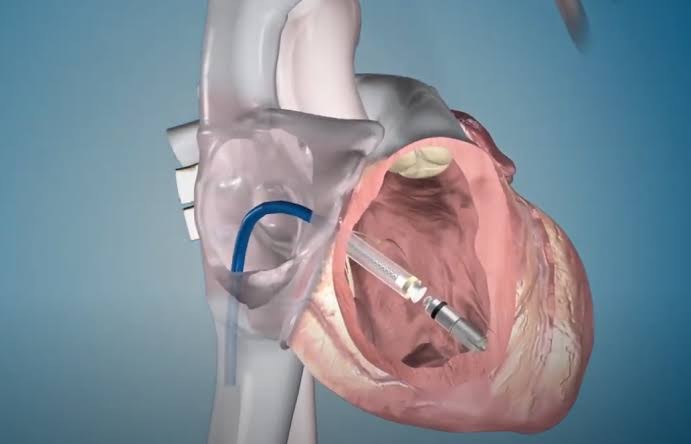 Leadless Pacemaker