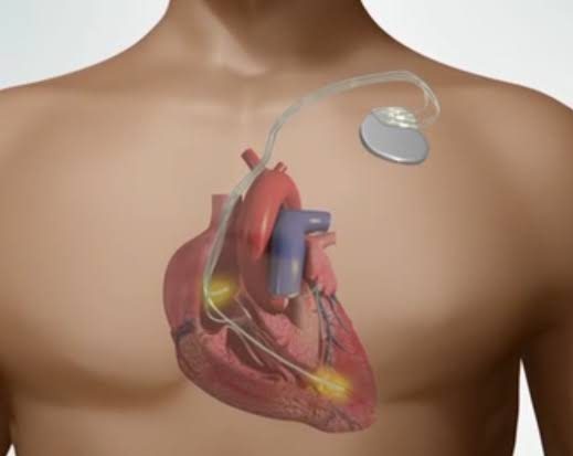 ICD Implantation in Jaipur