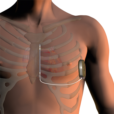 ICD Implantation in Jaipur