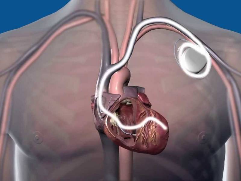 CRTD Implantation in Jaipur