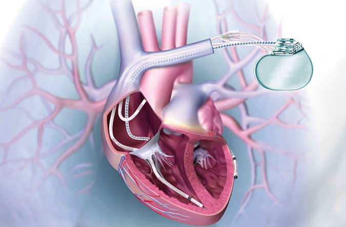 CRTD Implantation in Jaipur